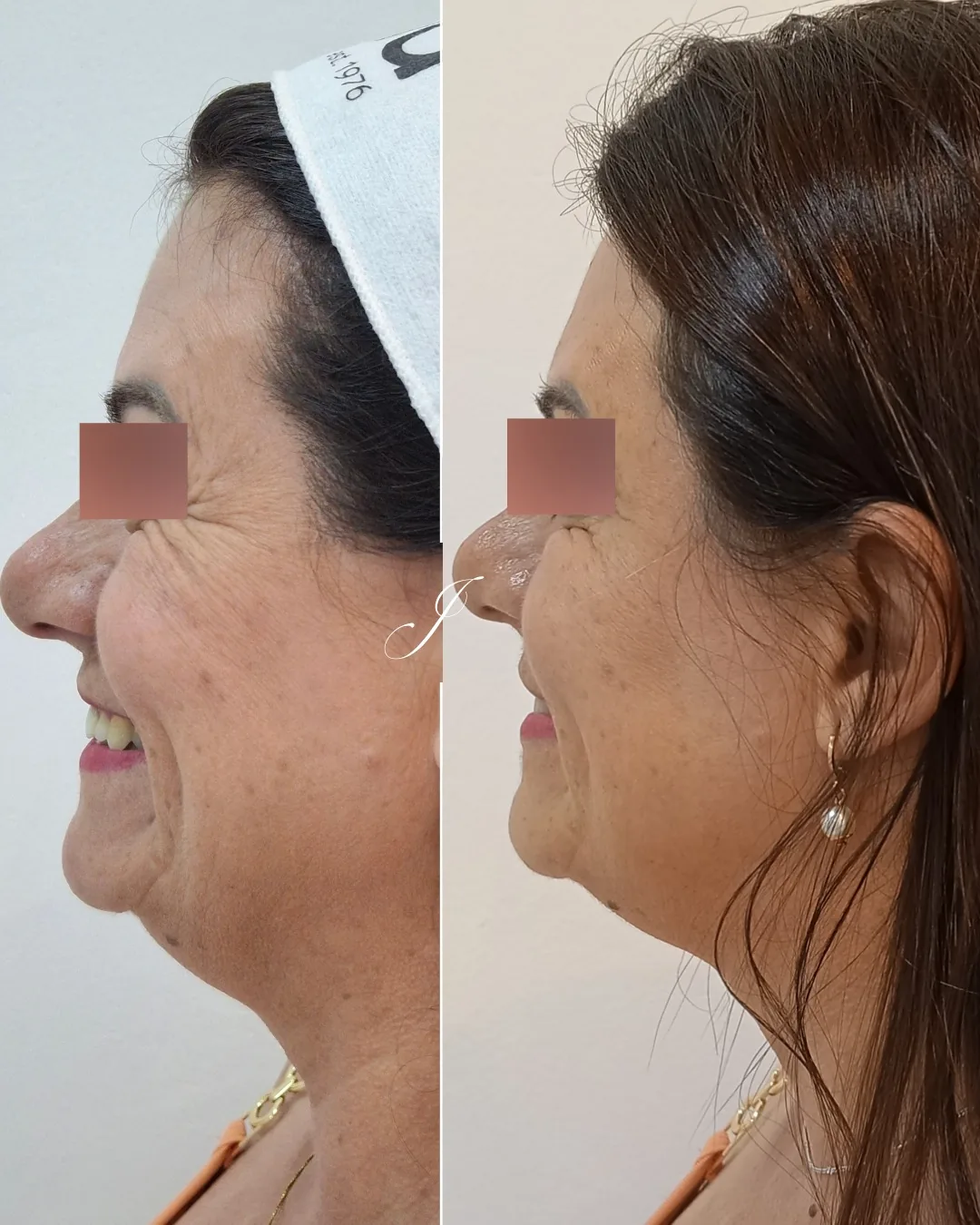 Antes e depois de harmonização facial feminina com naturalidade