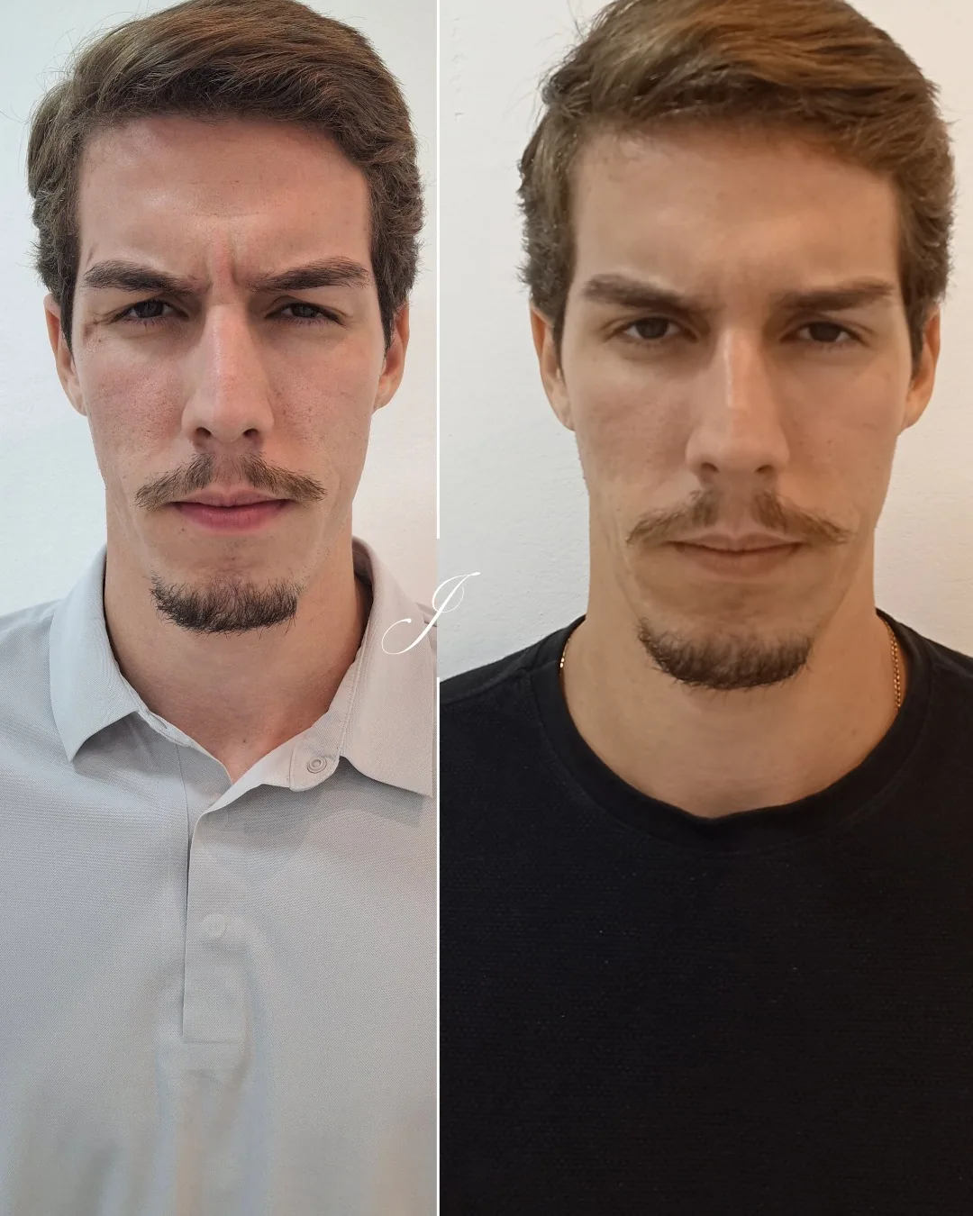 Antes e depois de harmonização facial masculina com resultado natural